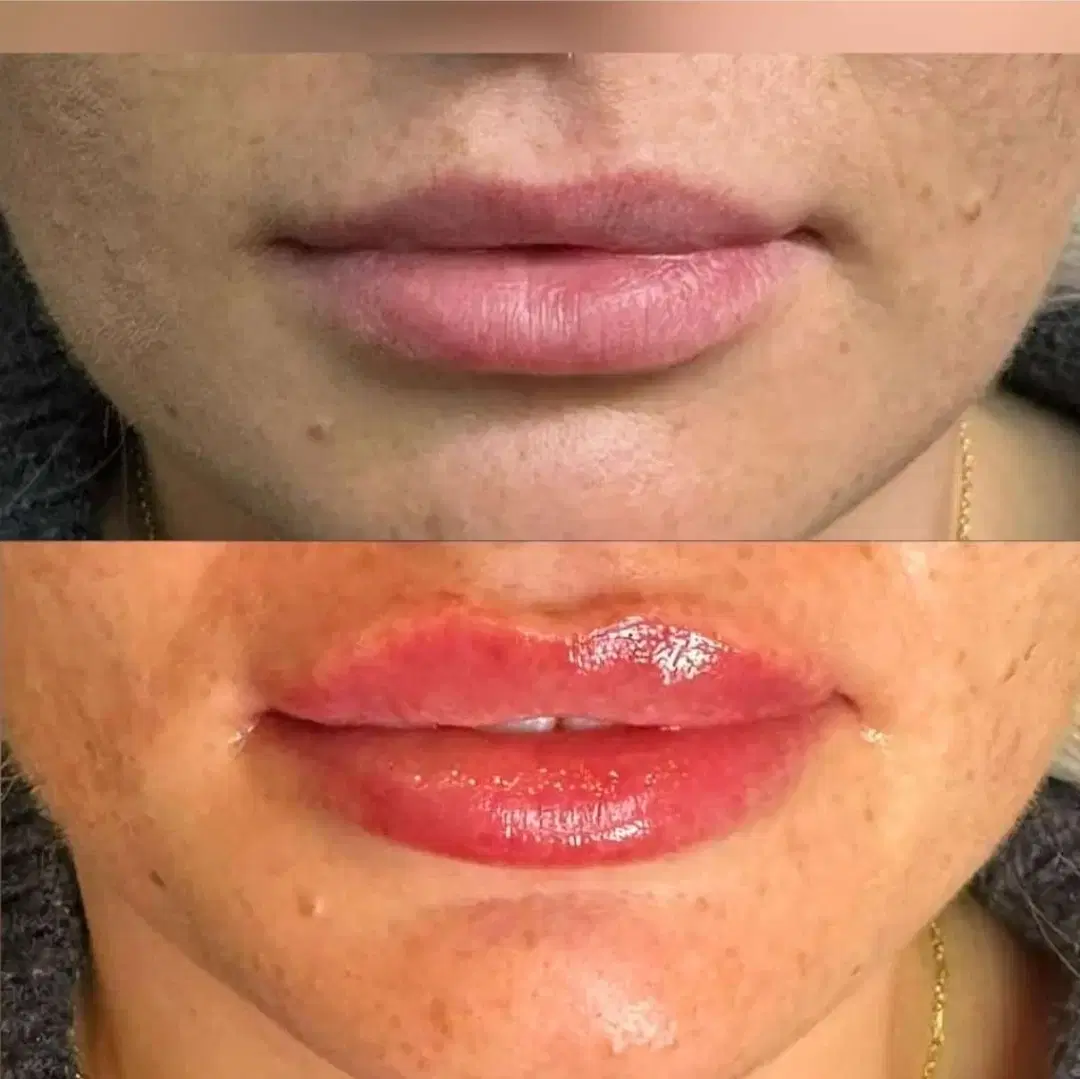 تزریق ژل|خدمات آرایشگری و زیبایی|بندر گناوه, |دیوار