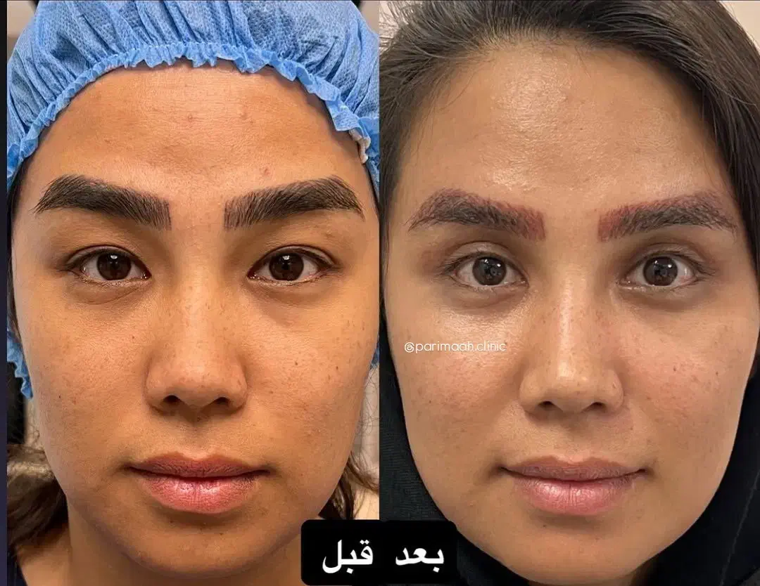 بلفاروپلاستی، پاک کردن تتو، ژل لب، وایتنینگ پوست|خدمات آرایشگری و زیبایی|باقرشهر, |دیوار