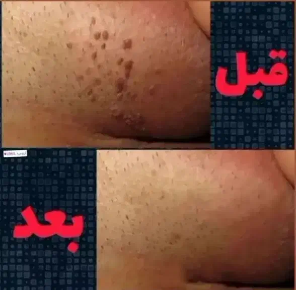 رفع دائمی زگیل و تبخال تناسلی|آرایشی، بهداشتی، درمانی|شیراز, شهرک گلها|دیوار