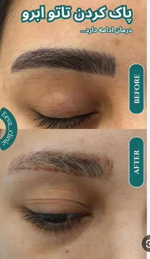 پاک کردن تتو ابرو بدن|خدمات آرایشگری و زیبایی|مشهد, نوید|دیوار