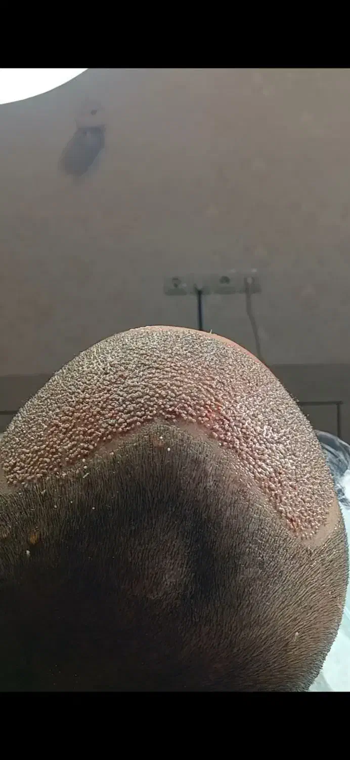 کاشت موی طبیعی فول تراکم|خدمات آرایشگری و زیبایی|ساری, |دیوار