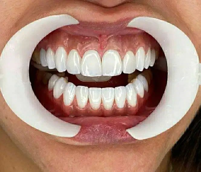 دندانپزشکی زیبایی تخفیف شب یلدااقساط|خدمات آرایشگری و زیبایی|پارس‌آباد, |دیوار