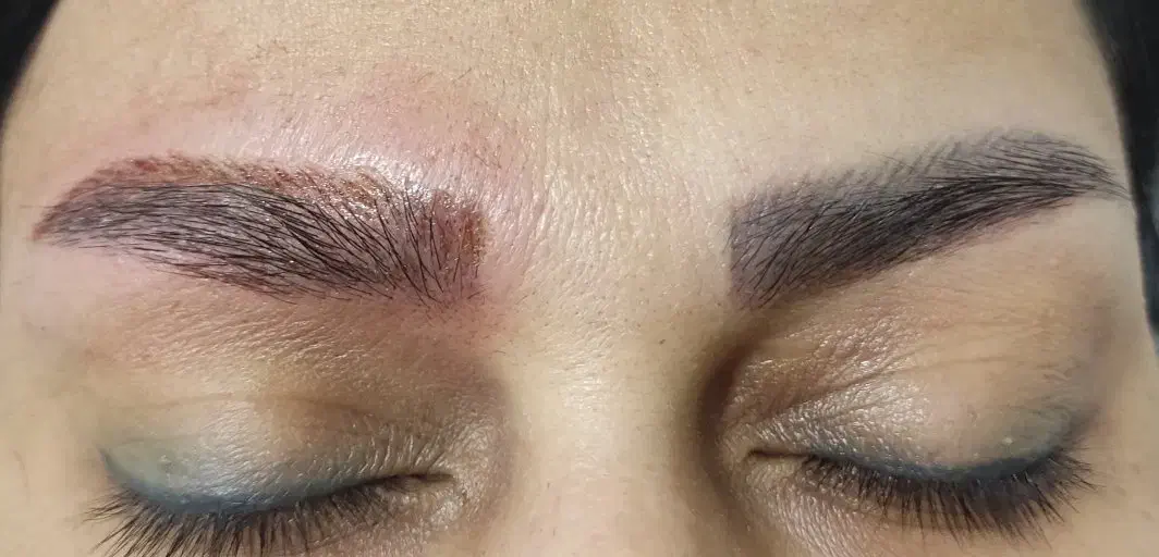 پاک کردن تتو(ریموو تتو)|خدمات آرایشگری و زیبایی|کرمانشاه, |دیوار