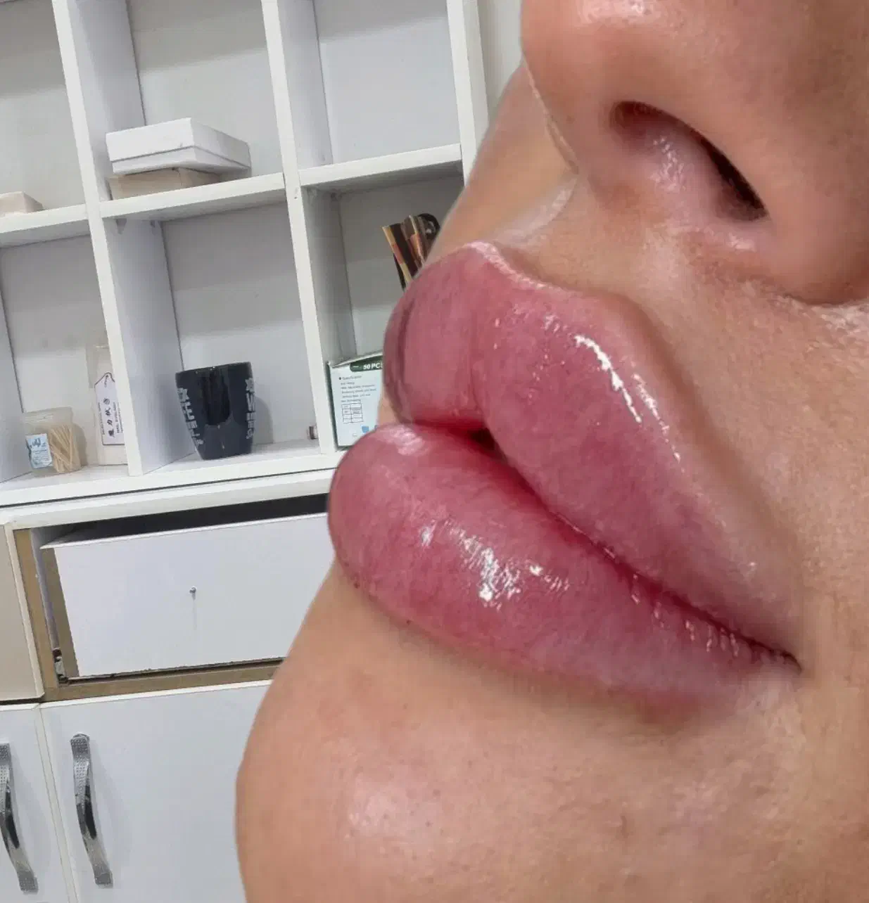 ژل بوتاکس خالبرداری|خدمات آرایشگری و زیبایی|زابل, |دیوار