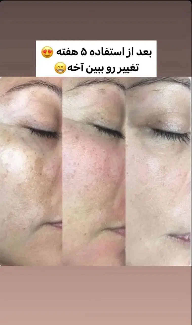 کرم ضدلک لاکچری کوین  فرانسوی|آرایشی، بهداشتی، درمانی|شیراز, طلاب|دیوار
