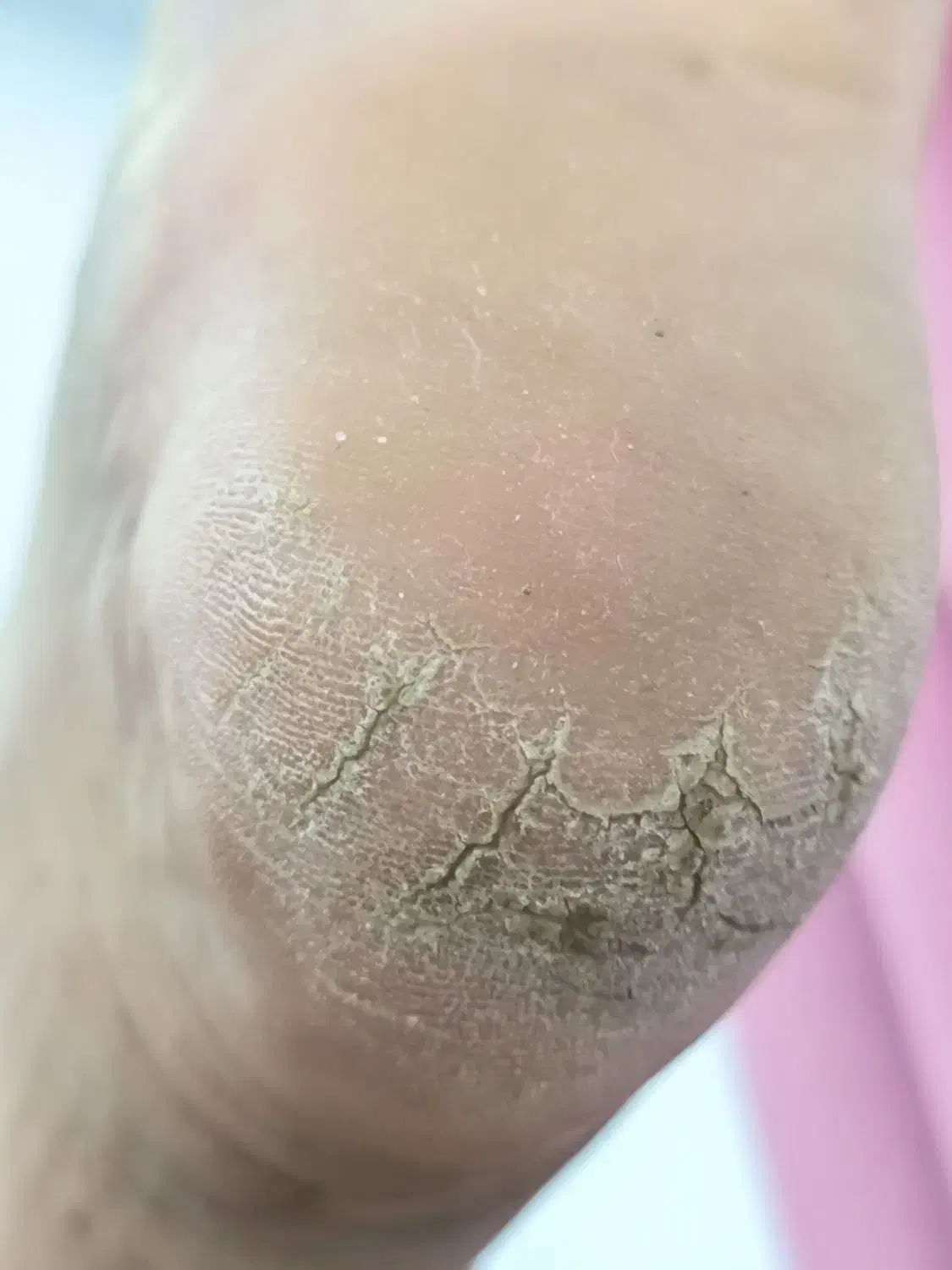 دوست داری ترک پاهات درمان بشه با یه قیمت منصفانه|خدمات آرایشگری و زیبایی|بندر انزلی, نوروزی|دیوار