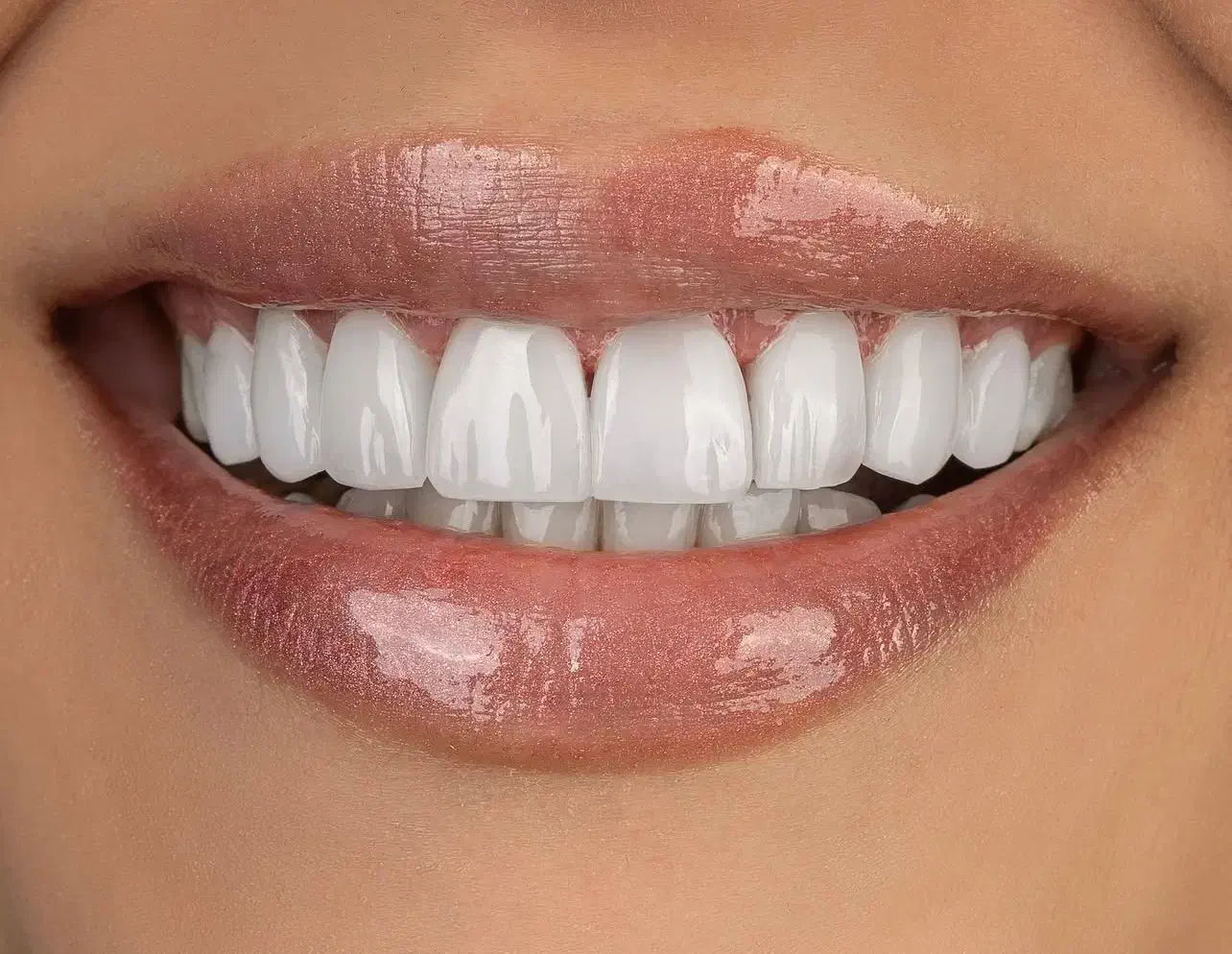 کامپوزیت دندان از دم قسط|خدمات آرایشگری و زیبایی|تهران, بلوار کشاورز|دیوار