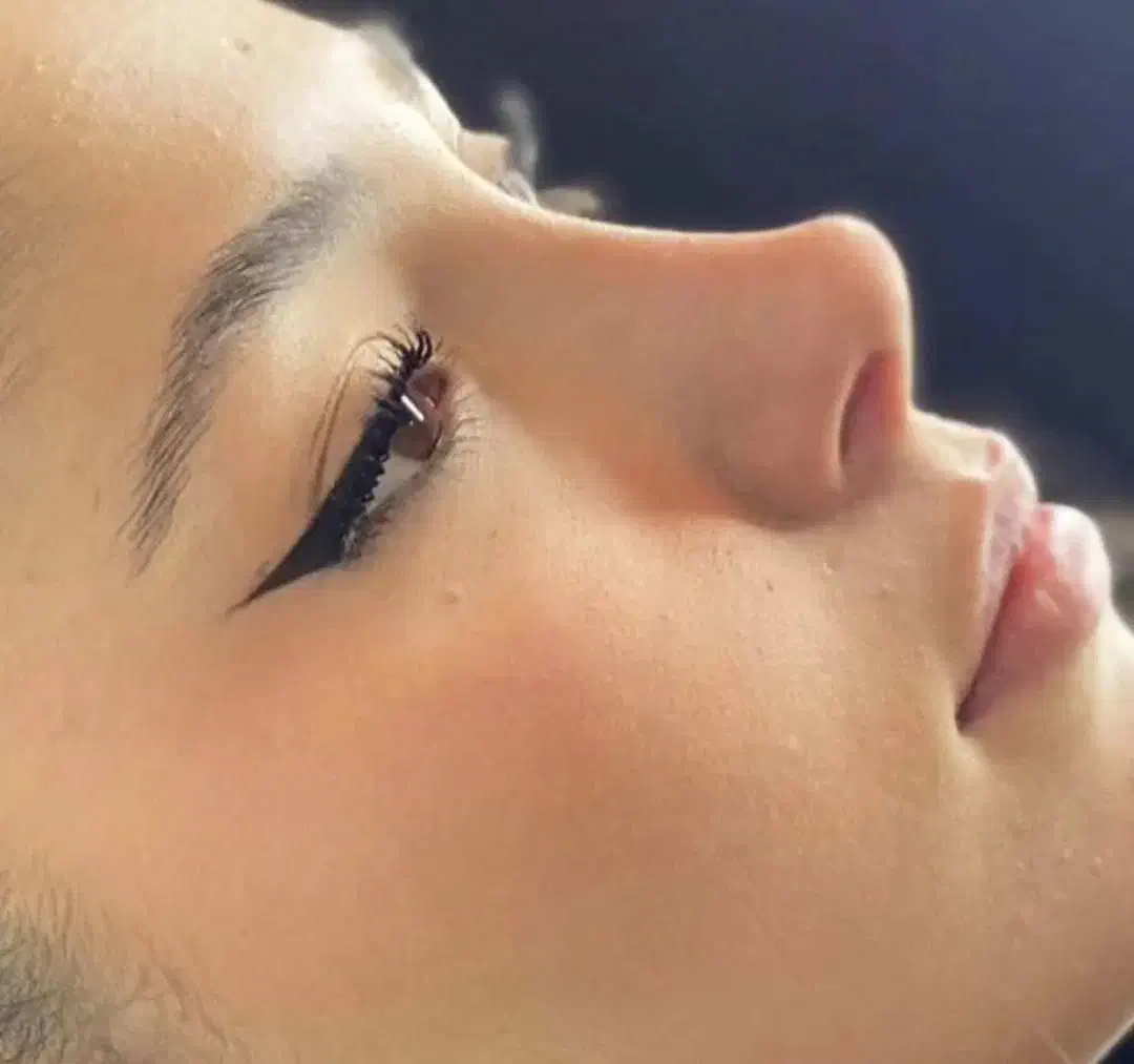 جراحی بینی با تخفیف باورنکردنی 50درصد|خدمات آرایشگری و زیبایی|قرچک, شهرک طلائیه|دیوار