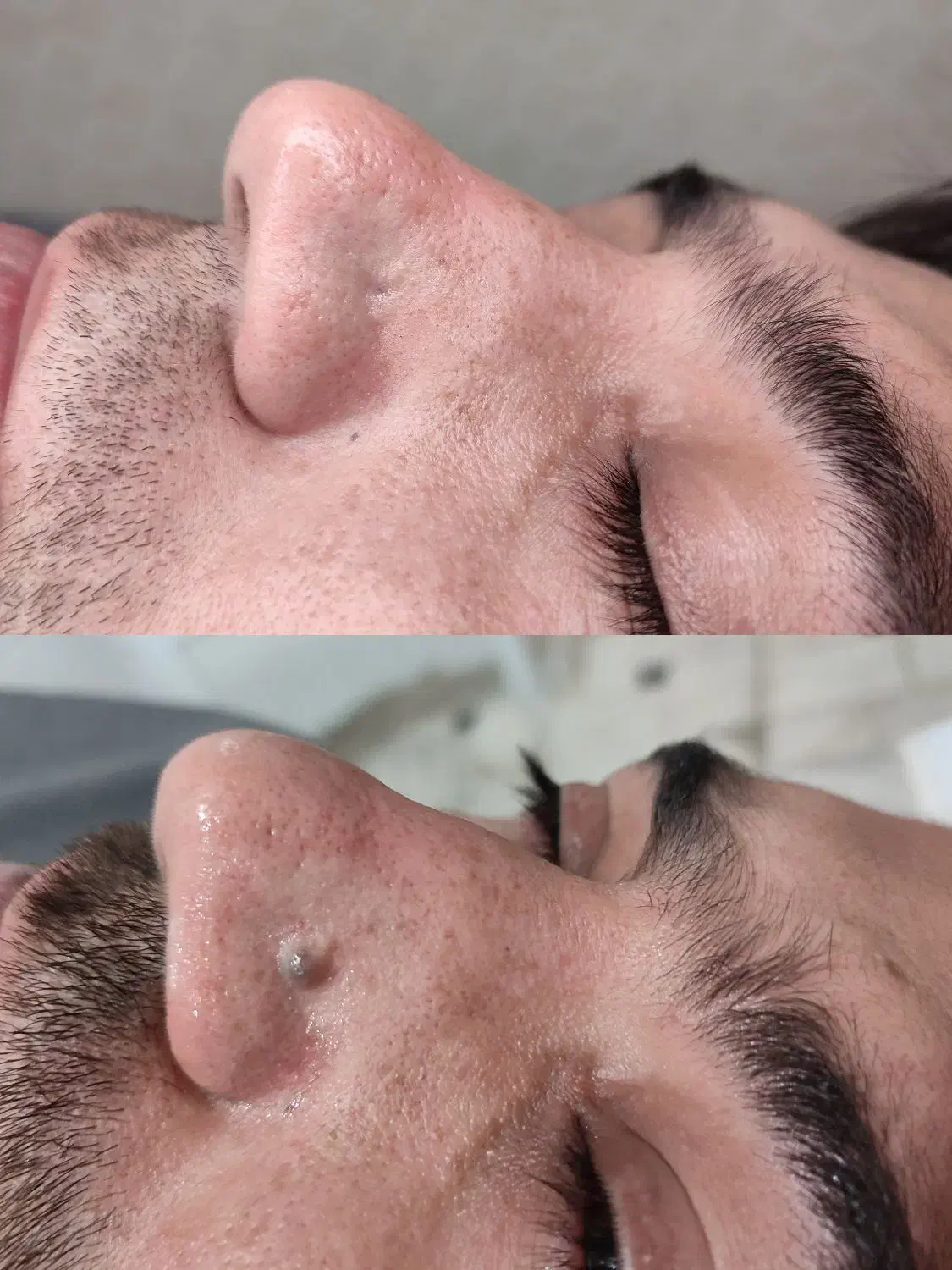 لیزر خال /میخچه زگیل/ ژل بوتاکس|خدمات آرایشگری و زیبایی|قم, صفائیه|دیوار