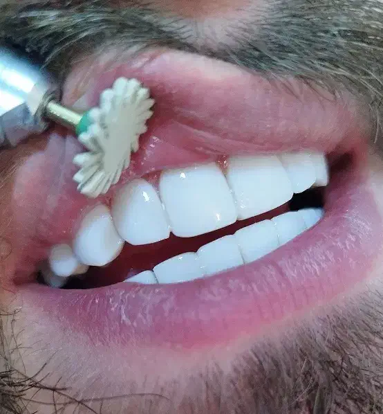 کامپوزیت دندان|خدمات آرایشگری و زیبایی|زنجان, |دیوار