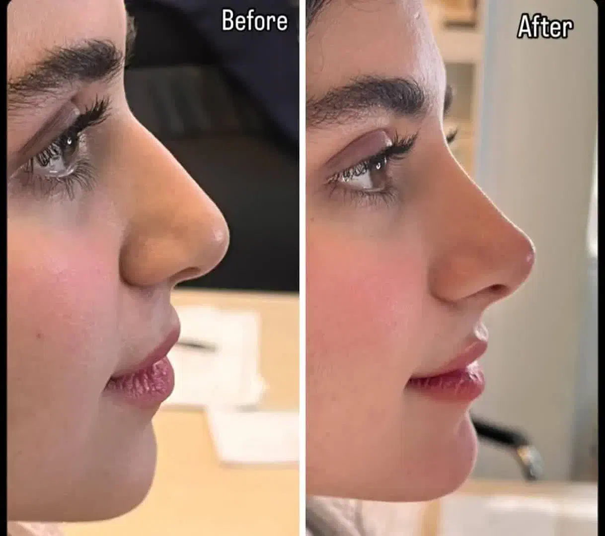 جشنواره ۵۰ درصدی ژل بوتاکس فقط تا سه روز|خدمات آرایشگری و زیبایی|اصفهان, برازنده|دیوار