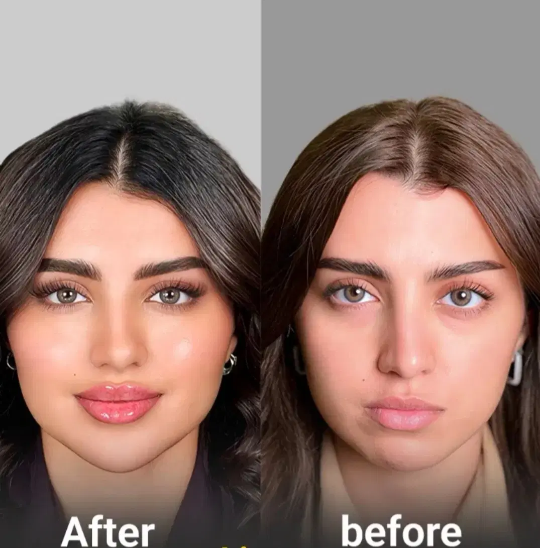فیلر ژل لیزر پلاژن پی ارپی هایفو صورت زاویه فک|خدمات زیبایی و سلامت|مشهد, هنرستان|دیوار
