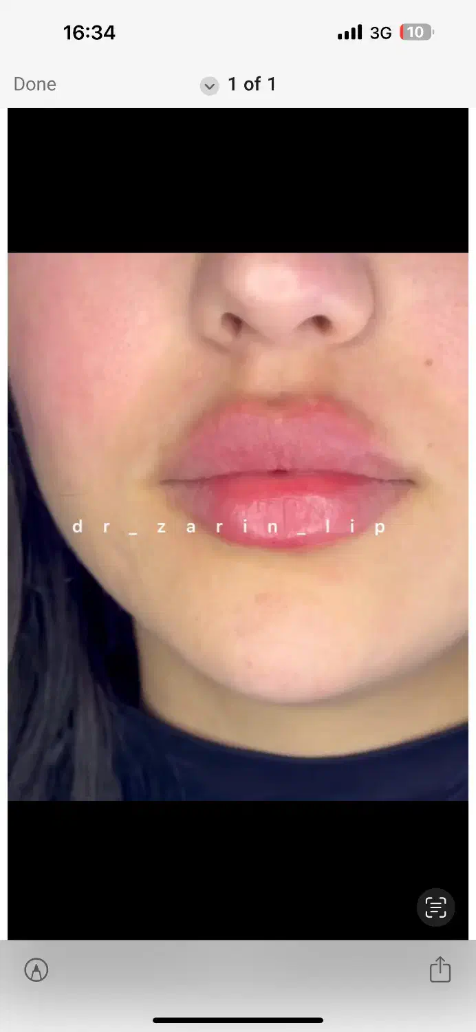 کلینیک تخصصی تزریق فیلر/ژل لب روسی/مادلینگ نچرال|خدمات آرایشگری و زیبایی|تهران, الهیه|دیوار