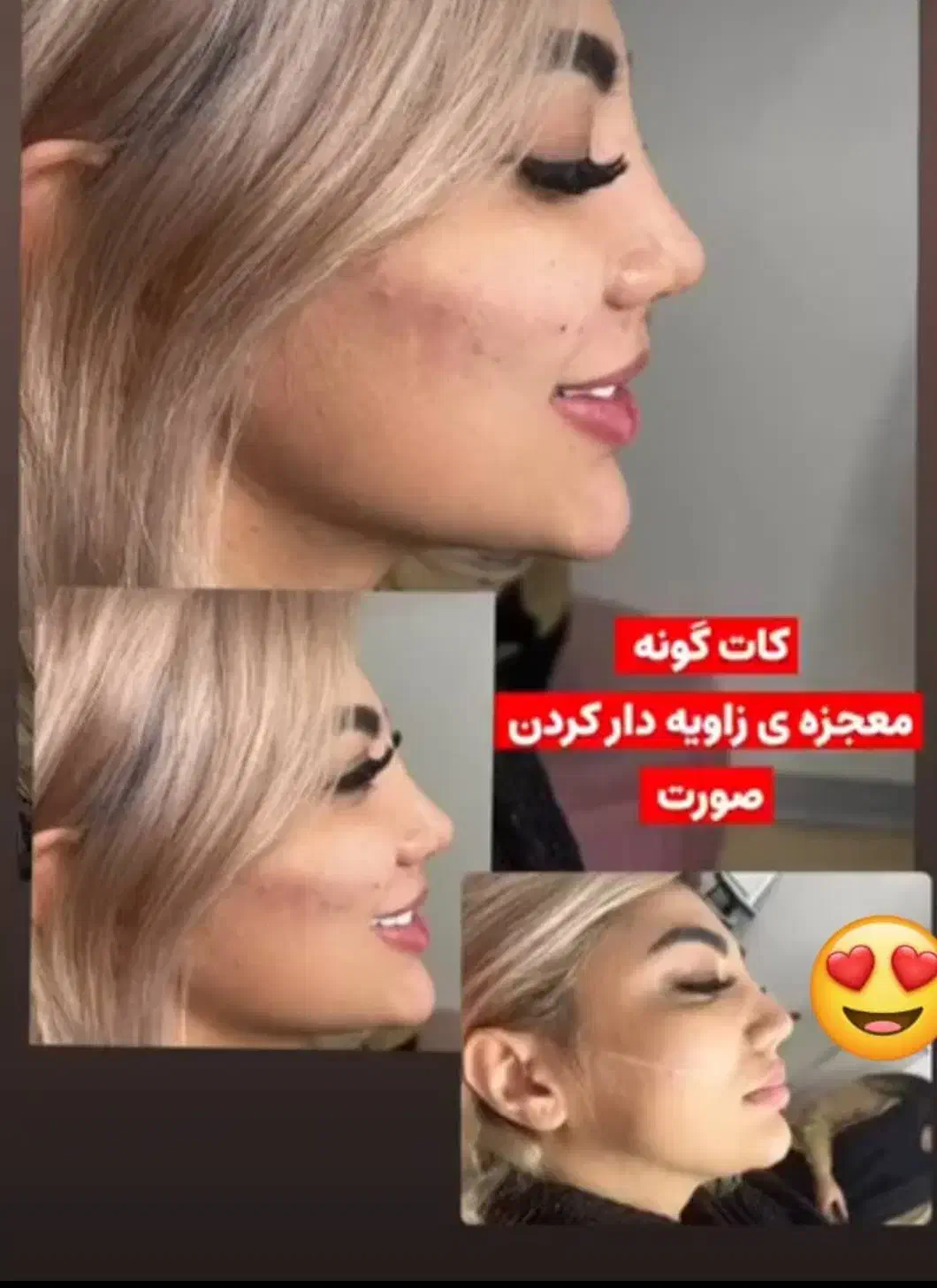 تزریق ژل و بوتاکس و مزو ژل|خدمات آرایشگری و زیبایی|فسا, |دیوار