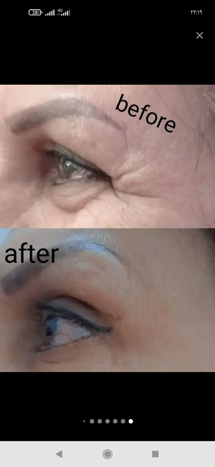 تخفیف بوتاکس و ژل|خدمات آرایشگری و زیبایی|دورود, |دیوار