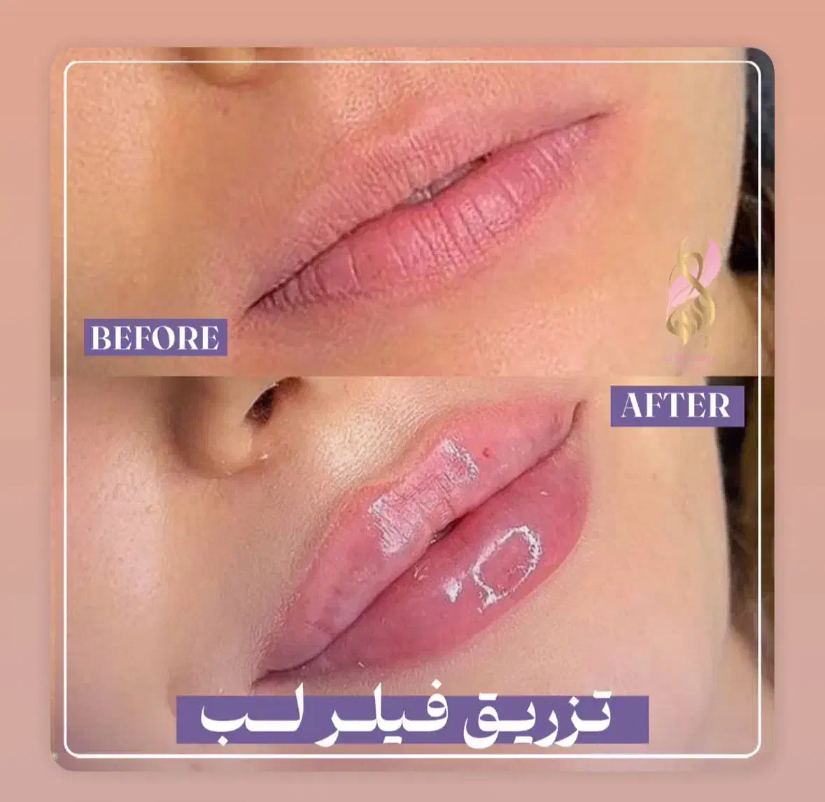 فیلر لب ۱/۶۰۰/تاپایان این هفته|خدمات آرایشگری و زیبایی|رشت, کوی حسینی|دیوار