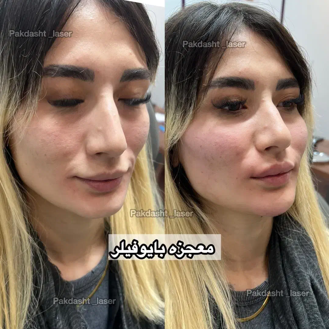 تزریق بایوفیلر کل صورت نچرال و طبیعی|خدمات آرایشگری و زیبایی|پاکدشت, پاکدشت (مامازند)|دیوار