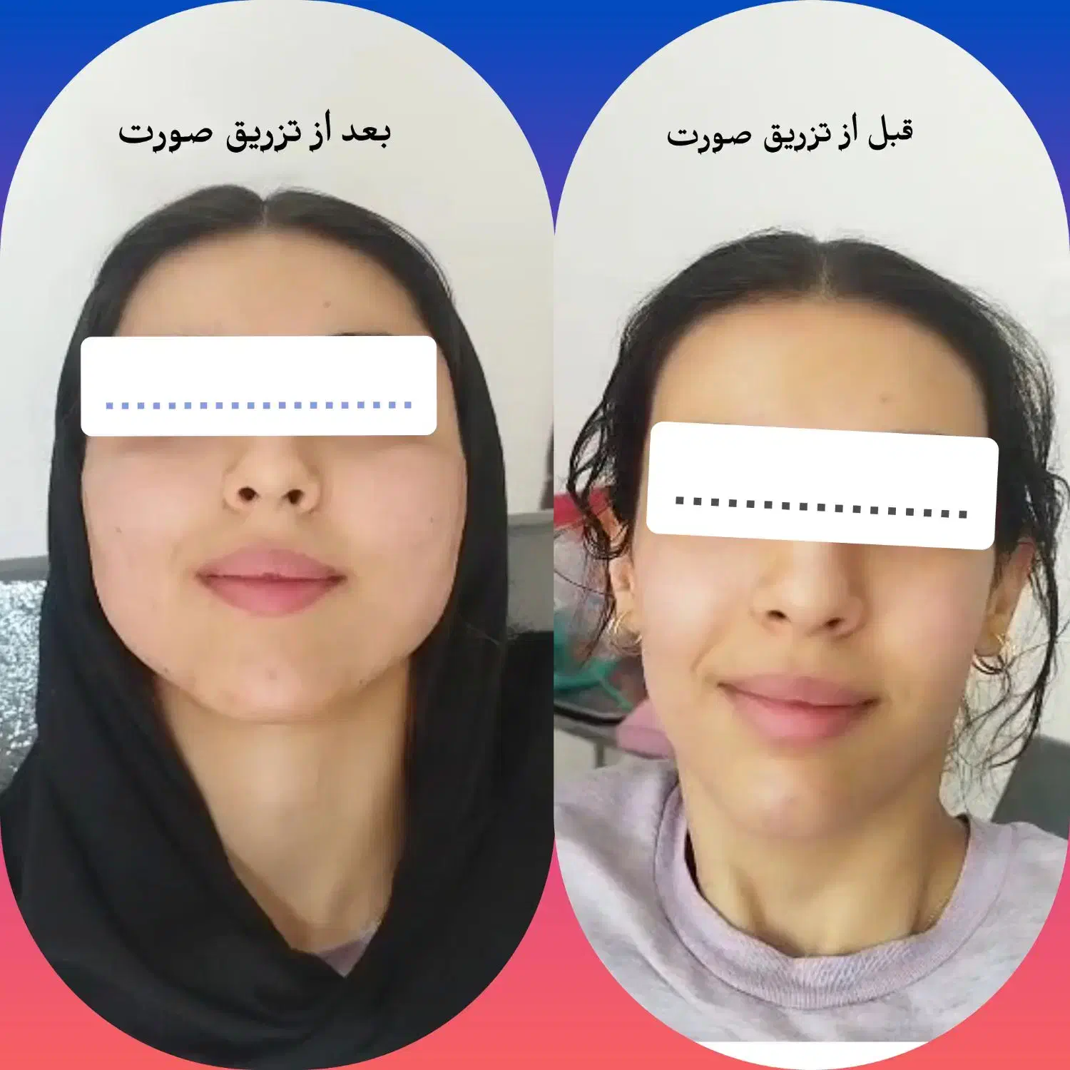 تخلیه وتزریق چربی لابیا جراحی پلک دایرکت اتوپلاستی|خدمات آرایشگری و زیبایی|دورود, |دیوار