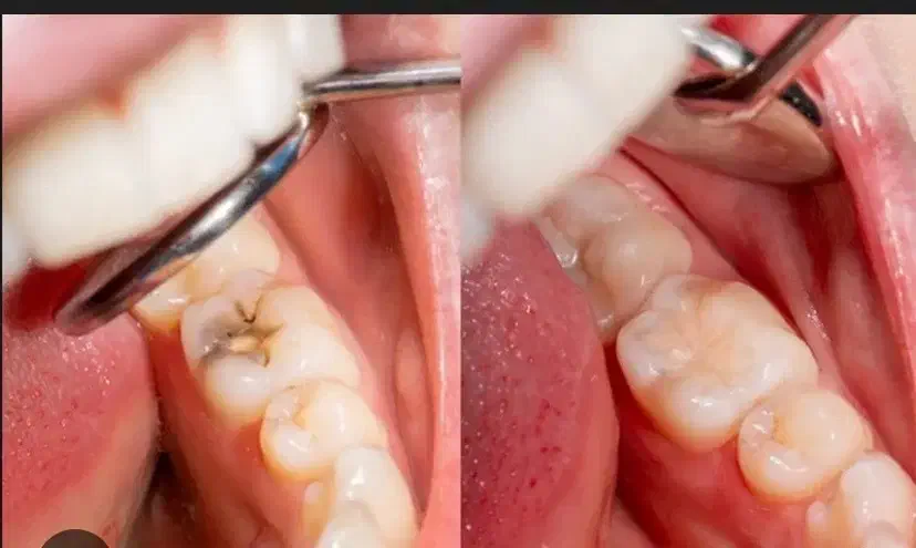 عصب کشی دندان های مولر (کرسی)|خدمات آرایشگری و زیبایی|بیرجند, |دیوار