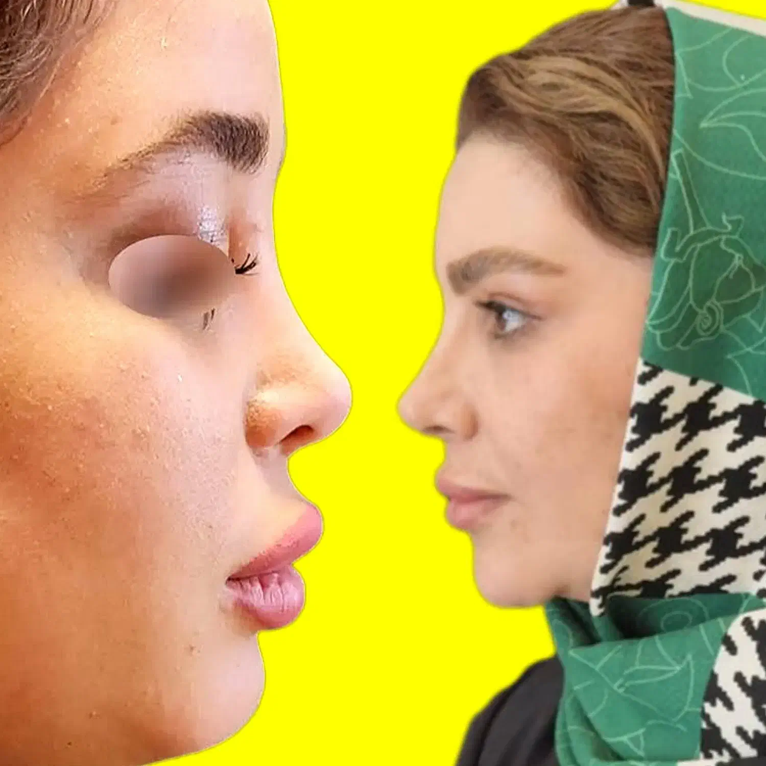 جراحی بینی اقساطی (با ۱۸ تومن پیش پرداخت )|خدمات آرایشگری و زیبایی|رشت, گلباغ نماز|دیوار