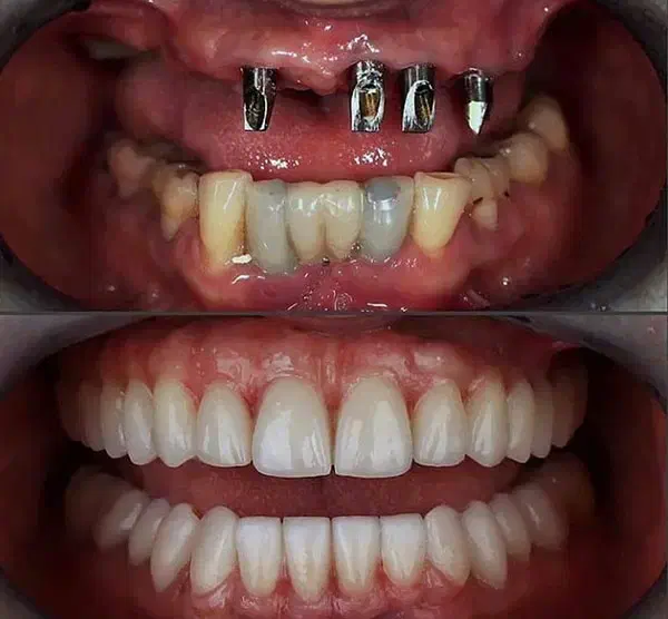 جشنواره ایمپلنت و اور دنچر|خدمات آرایشگری و زیبایی|بستان آباد, |دیوار