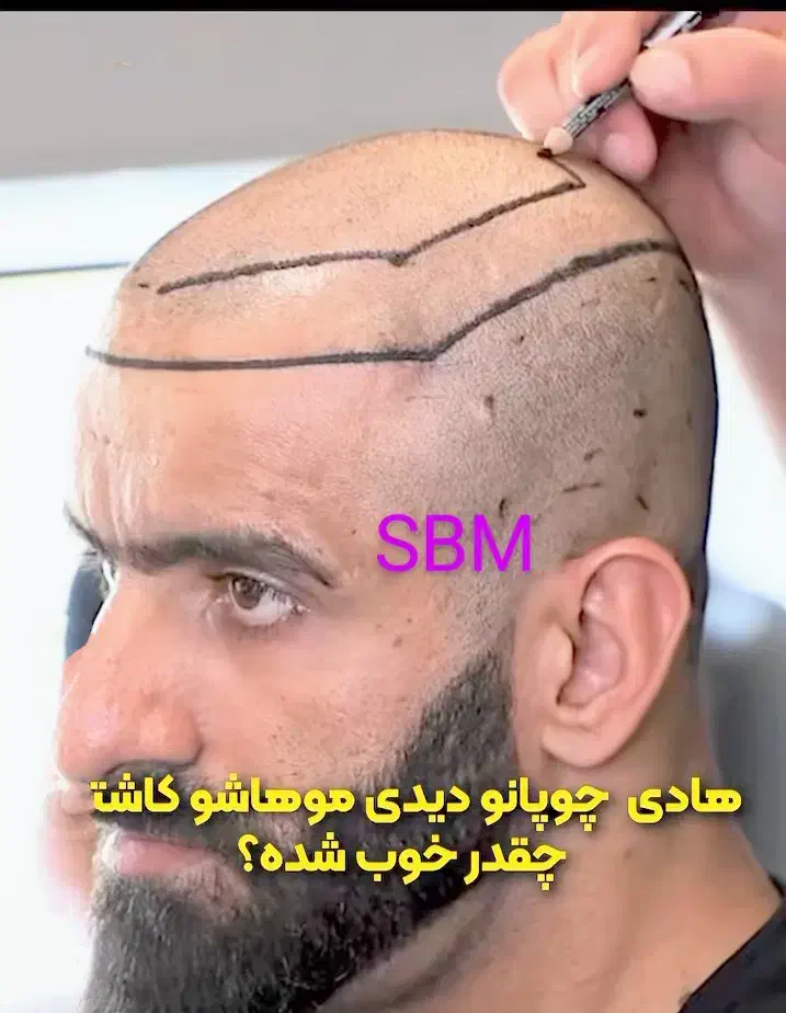 کاشت فوق حرفه/جدیدترین متدسوپرمیکروit+ مو/ابرو/ریش|خدمات آرایشگری و زیبایی|مشهد, هفت تیر (آب و برق)|دیوار