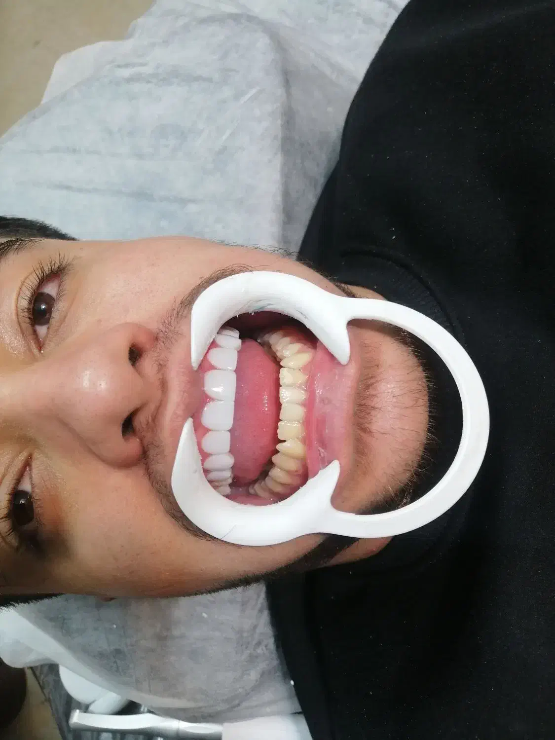 کامپوزیت دندان هر فک 5تومن|خدمات آرایشگری و زیبایی|محمدشهر, محمدشهر|دیوار