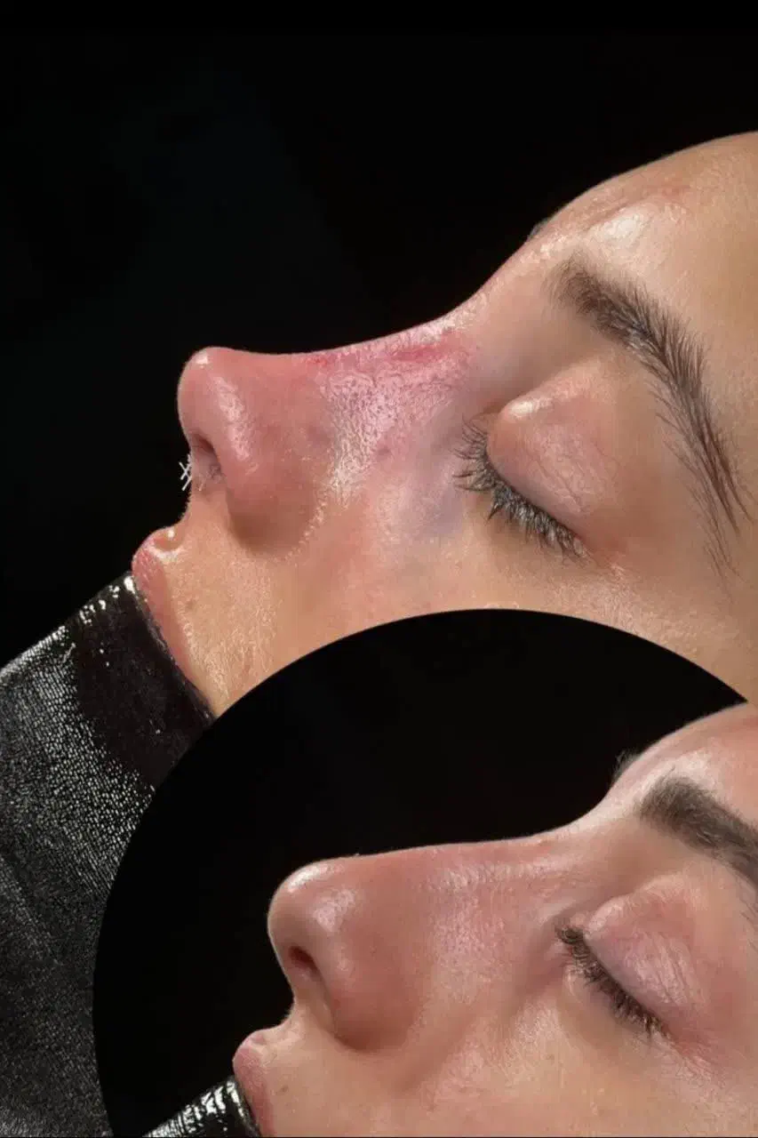 عمل و جراحی بینی 23تا25 میلیون /مشاوره رایگان|خدمات آرایشگری و زیبایی|کرج, عظیمیه|دیوار