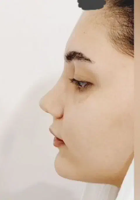 عمل بینی|خدمات آرایشگری و زیبایی|خرم‌آباد, |دیوار