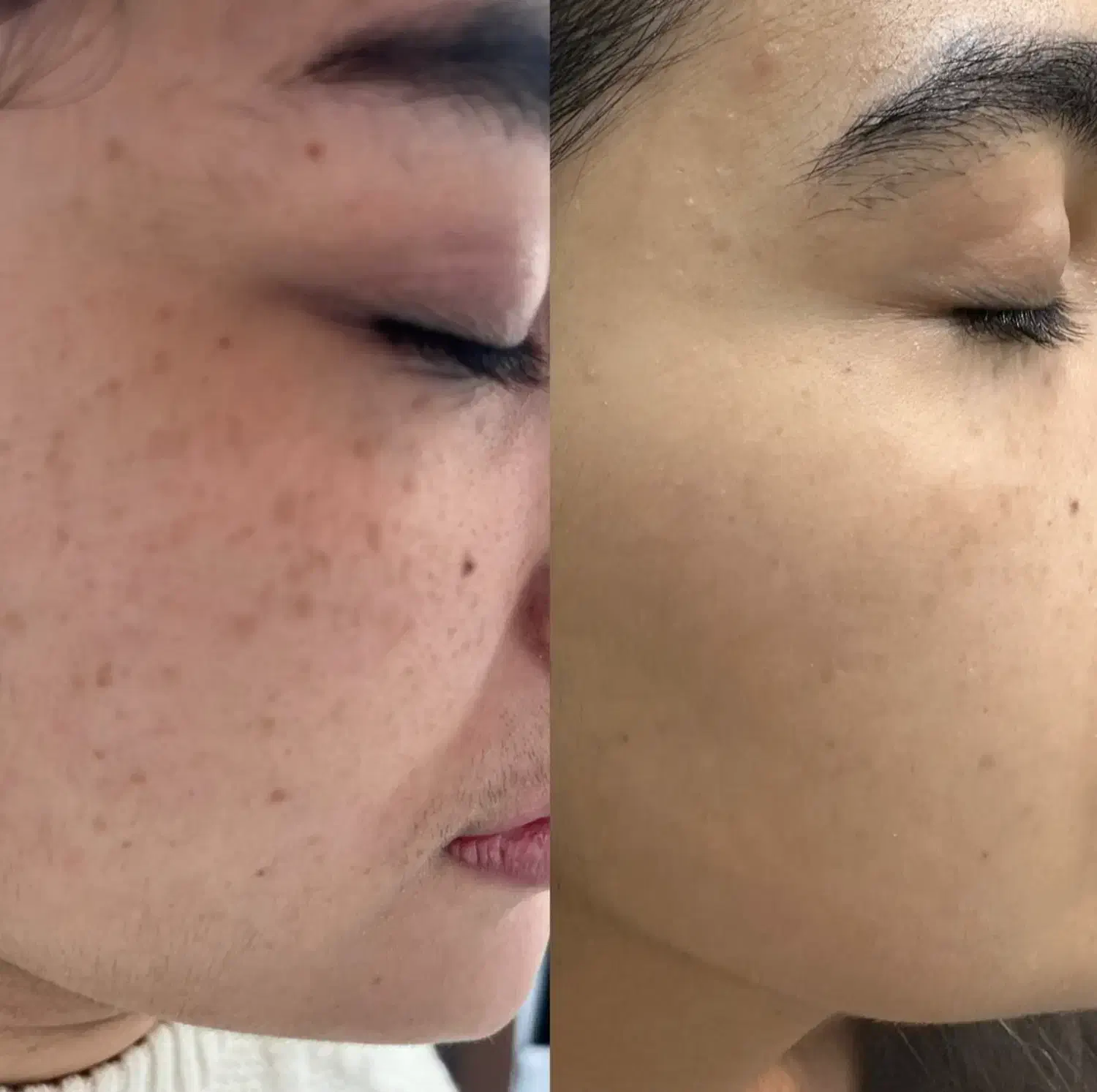 لیزر ، الکترولیز ، روشن سازی ، کک‌ و مک توسط پزشک|خدمات آرایشگری و زیبایی|بندرعباس, |دیوار