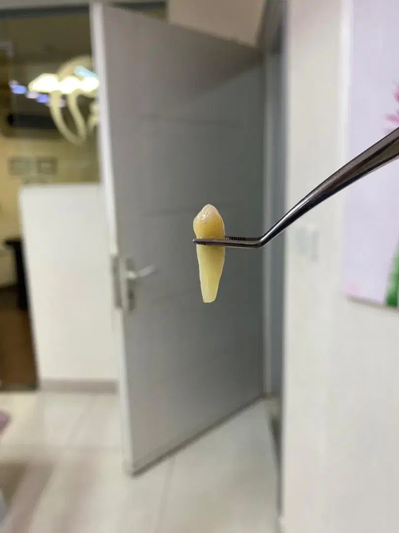 فروش دندان های خلفی4.5سالم|پزشکی|رشت, سعدی (تختی)|دیوار