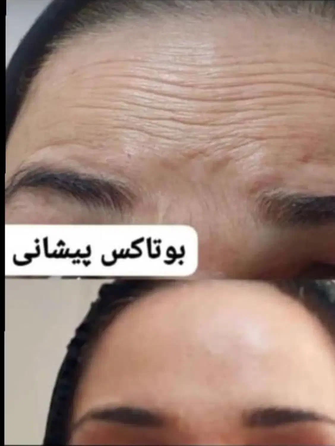 اف ویژه زیبایی تزریق ژل، بوتاکس، پی ار پی|خدمات آرایشگری و زیبایی|اهواز, کمپلو جنوبی|دیوار