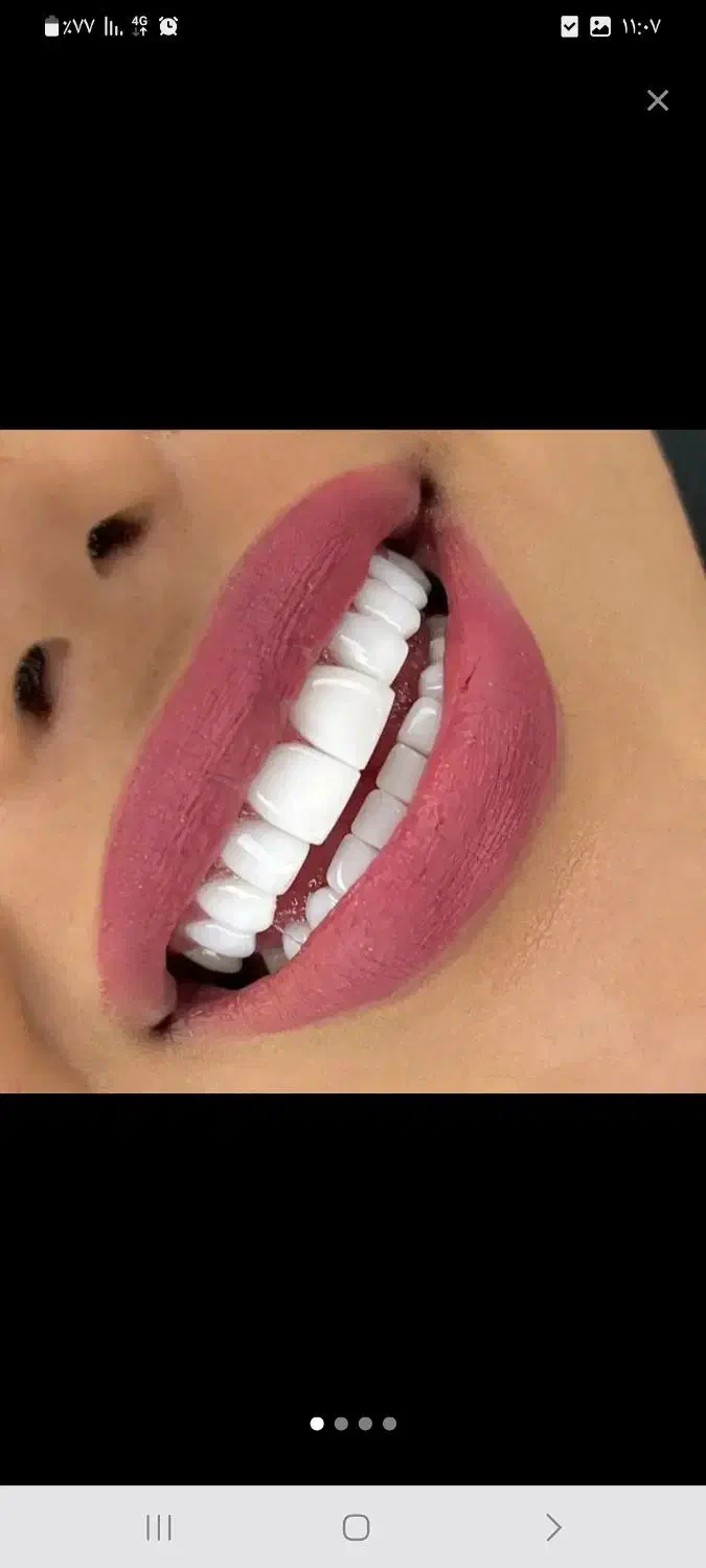 تخفیف کامپوزیت لمینت با اقساط|خدمات آرایشگری و زیبایی|قم, مهدیه|دیوار