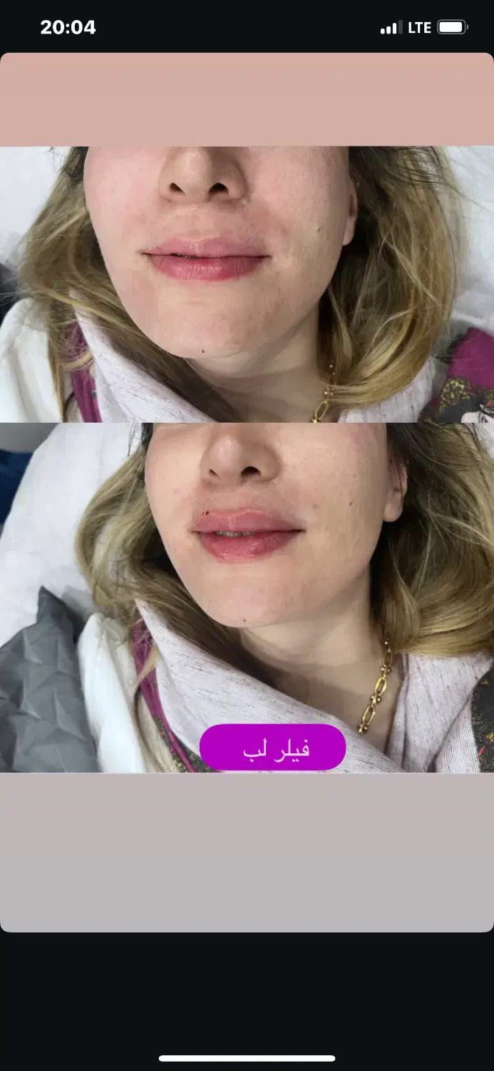 جشنواره پاییزه بوتاکس و فیلر و لیزر با تخفیف۳۰درصد|خدمات آرایشگری و زیبایی|اصفهان, فیض|دیوار