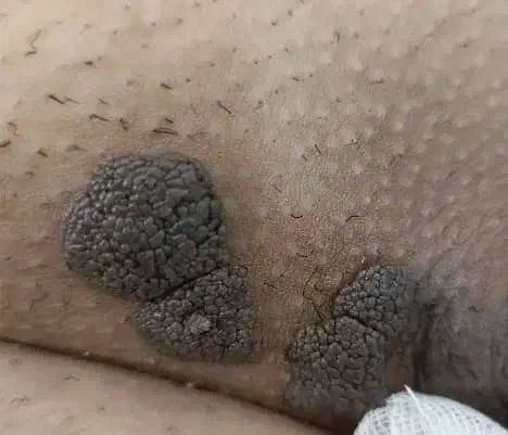 لیزرتتوبدن،ابرو،لیزرخال،زیگیل تناسلی،درمانhpv|خدمات آرایشگری و زیبایی|کرج, گلشهر|دیوار
