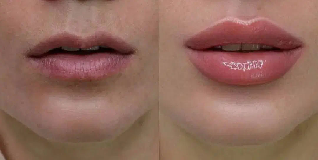 آنزم و مزو تراپی و فیلر و بوتاکس|خدمات آرایشگری و زیبایی|قرچک, مهدیه|دیوار