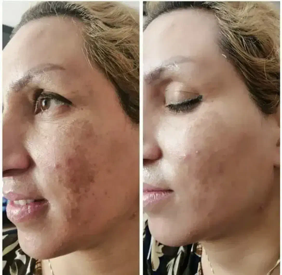 کرم  ضد لک و سفید کننده تضمینی|آرایشی، بهداشتی، درمانی|کیش, |دیوار