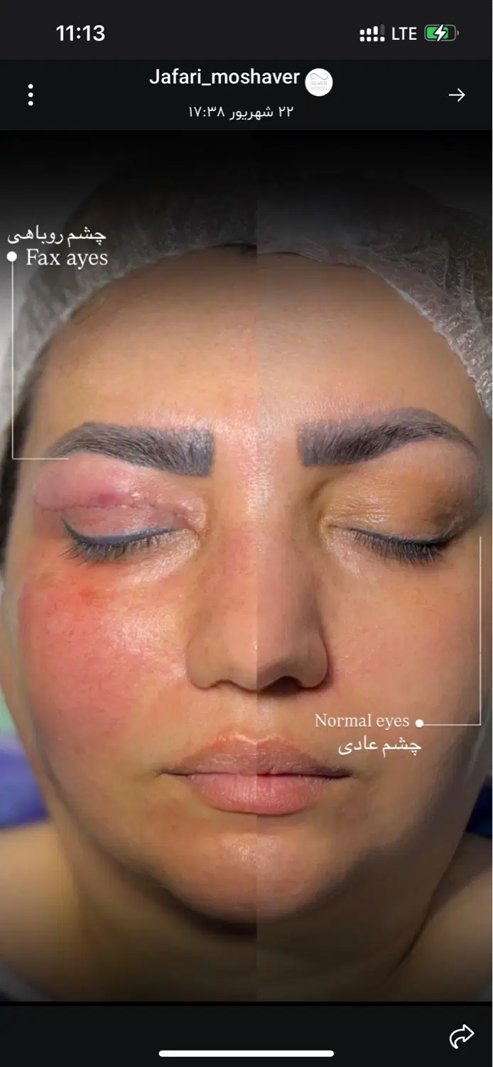 جراحی بلفارو پلاستی نیم بها|خدمات زیبایی و سلامت|تهران, فیروزآبادی|دیوار