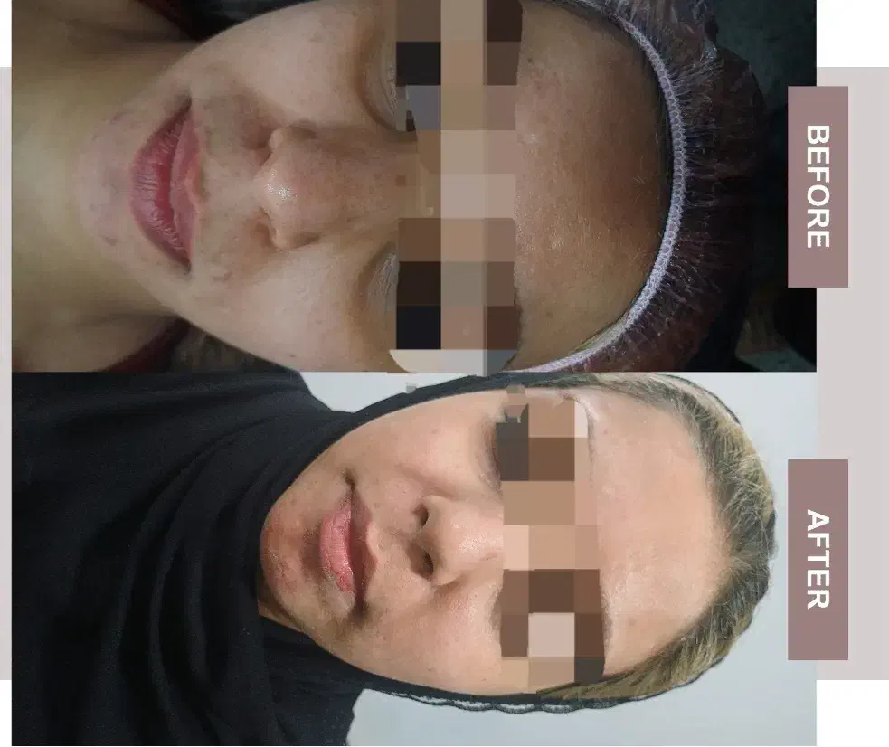 آف 30% فیشیال تخصصی  + مشاوره ی رایگان|خدمات آرایشگری و زیبایی|اهواز, نادری|دیوار