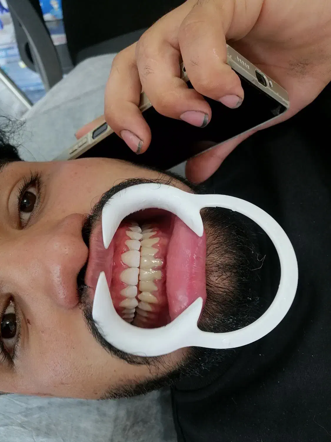 کامپوزیت دندان هر فک 5تومن|خدمات آرایشگری و زیبایی|محمدشهر, محمدشهر|دیوار