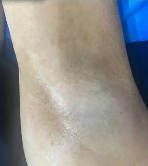 لیزر مو باتخفیف و ریزش ۹۹درصدی چهارصد|خدمات آرایشگری و زیبایی|زنجان, |دیوار