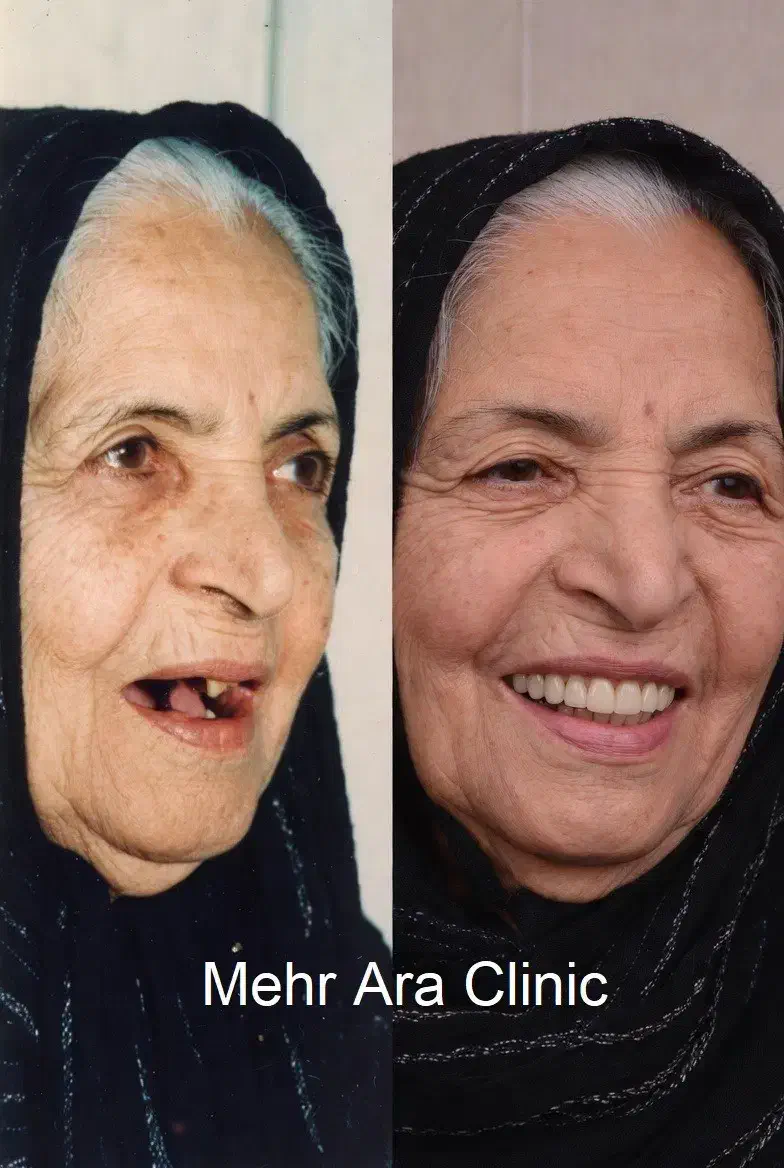 ایمپلنت با روکش هدیه 12.600 محدود|خدمات آرایشگری و زیبایی|تهران, ستارخان|دیوار