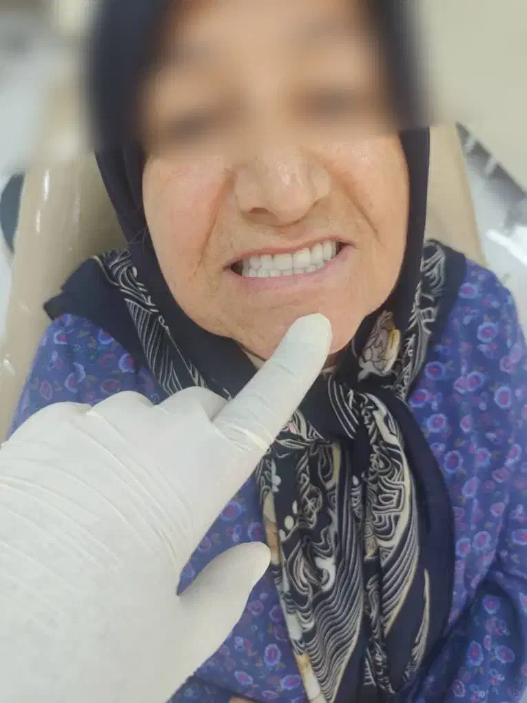 ساخت دندان مصنوعی با کم ترین قیمت|خدمات آرایشگری و زیبایی|تهران, جیحون|دیوار
