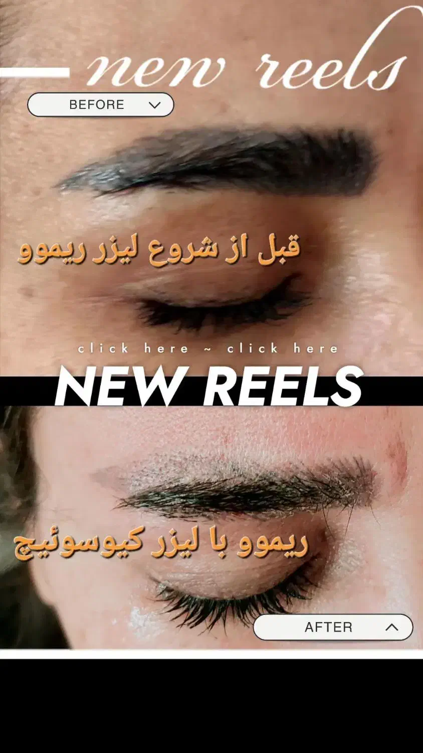 پاک کردن تتو///خدمات لیزر کیوسوئیچ و پیلینگ کربن|خدمات آرایشگری و زیبایی|صدرا-فارس, فاز ۱|دیوار