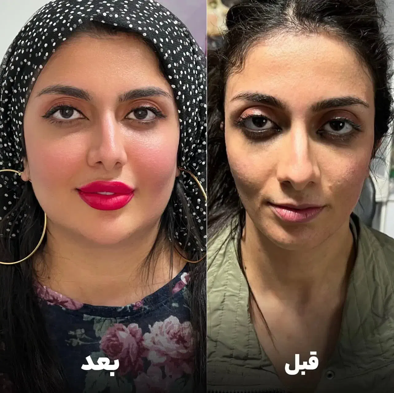 جشنواره  فیلر بیکینی مدلینگ ،بوتاکس ،شقیقه زیر چشم|خدمات آرایشگری و زیبایی|تهران, اختیاریه|دیوار