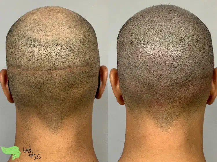 کاشت مو|خدمات آرایشگری و زیبایی|اهواز, نادری|دیوار