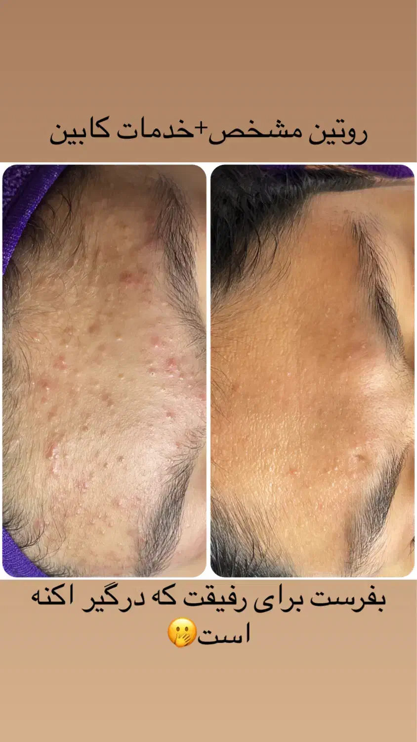 آموزش،پی ار پی مزوبوتاکس بایوفیلر غبغب چربی ساکشن|خدمات آرایشگری و زیبایی|اصفهان, شاهزید|دیوار