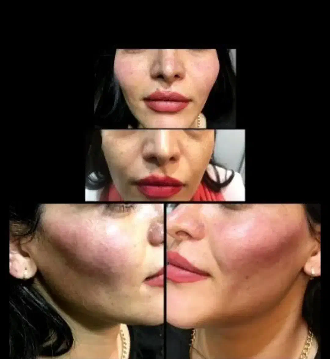 ژل ، بوتاکس ، چربی ، فیلر|خدمات آرایشگری و زیبایی|کرمانشاه, |دیوار