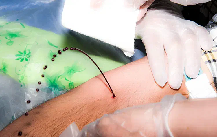 فصد پیشانی حجامت زالو درمانی|خدمات آرایشگری و زیبایی|ارومیه, |دیوار