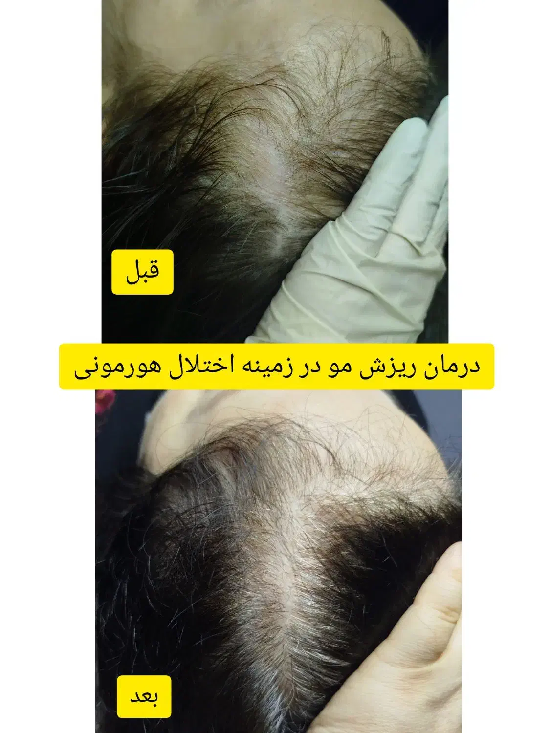 درمان ریزش مو|خدمات آرایشگری و زیبایی|رشت, بلوار گیلان|دیوار